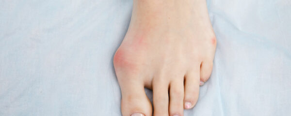 hallux valgus