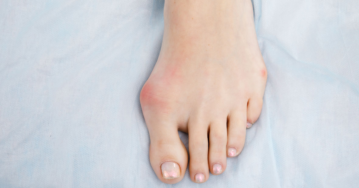 hallux valgus